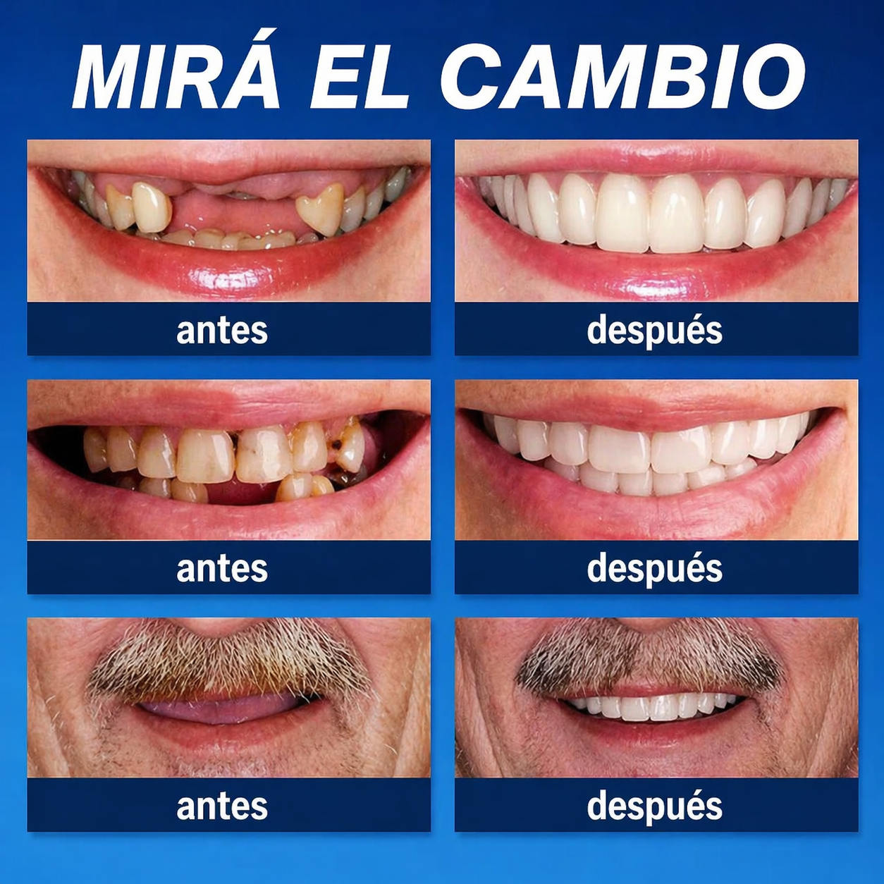 🎁🌎Ends Today: 70% OFF! ⏰meleval® Medical Full Denture with Strong Suctiond🦷Obtain American Dental Association (ADA) Certification